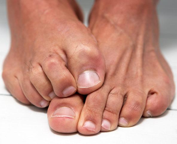 Um fungo insalubre nas unhas dos pés: tratamento com remédios populares
